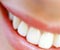 Отбеливание зубов – это несложная стоматологическая процедура, доступная сегодня широкому слою населения